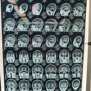 16 canais monitoramento intraoperatório sistema IONM médico profissional sistema neuromonitoring intraoperatório - Product Image 5