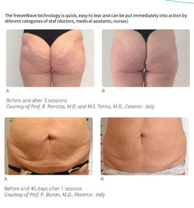 Sistema de Contorno Corporal Multifuncional de Grado Médico Onda Coolwaves de 2.45GHz para Uso Doméstico y Clínico - Product Image 6