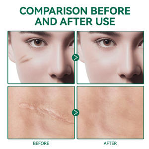 YURHERSU 실리콘 흉터 젤 C 섹션 수화물 및 평평한 흉터 모양 복구 피부 - Product Image 3