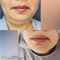 Liposuccion Vaser, lifting endolaser, laser diode 980 nm, appareil laser à fibre, resserrement cutané, lifting endolaser