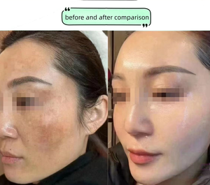 Iperpigmentazione causata da metalli pesanti nei cosmetici 4 In1 macchia della pelle Melasma per la pigmentazione del viso Peel rimuovere il Set di trattamento - Product Image 3