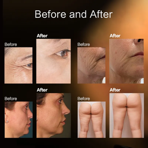 เครื่องมือความงามพกพา 2 in 1 สำหรับใช้ในบ้าน ปี 2026 ยกกระชับใบหน้าและรอบดวงตา ช่วยให้ผิวกระชับ - Product Image 6