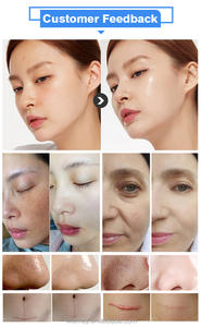 Nouvelle technologie oxygène Jet peel Machine de soins de la peau oxygène Jet d'eau Peel Machine faciale Hydrodermabrasion équipement facial - Product Image 6