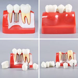 Modèle d'implant dentaire Dt M2017R, modèle anatomique en silicone médical pour l'enseignement des sciences médicales - Product Image 1