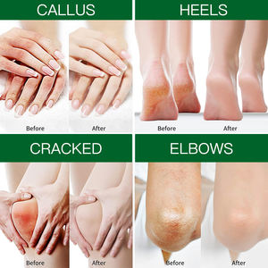 Custom Anti Crack Massage Shea Butter Dode Huid Verwijderen Whitening Ureum 40% Beste Hand-En Voetbleekcrème Reparatie Voetcrème - Product Image 5
