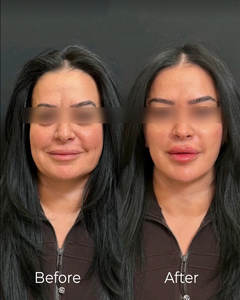 Hilos PDO MONO de Alta Calidad para Academias de Estética Médica/Lifting Facial, Directo de Fábrica, DDP DDU - Product Image 5