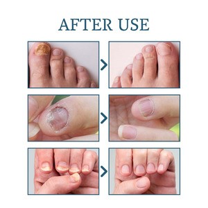 Suero para Eliminar Hongos en <span class=keywords><strong>las</strong></span> <span class=keywords><strong>Uñas</strong></span>, Anti Onicomicosis, Repara <span class=keywords><strong>Uñas</strong></span> Descoloridas y Dañadas, Esencia Nutritiva para el Cuidado <span class=keywords><strong>de</strong></span> <span class=keywords><strong>Manos</strong></span> y Pies - Product Image 4