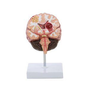 Modelo de Cerebro Humano con <span class=keywords><strong>Derrame</strong></span> Cerebral - Modelo Anatómico de Enfermedad Cerebral Patológica - Hemorragia Cerebral - Lesión Cerebral - Product Image 1