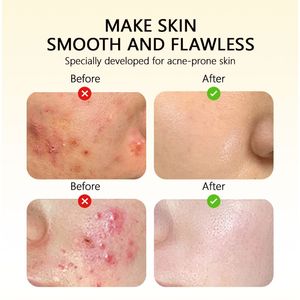 Crema Reparadora Profesional OEM 20g, Crema para el Cuidado de la Piel Antiacné, Crema Intensiva para Piel Propensa al Acné, Reparación Herbal Antiacné - Product Image 5
