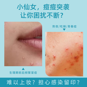 [Imprescindible para las haditas] Parches impermeables para el acné que cubren las cicatrices del acné, suaves y no irritantes, cubren el maquillaje, con diseño de estrella - Product Image 5