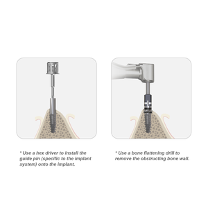 Huaplant Perno Guida Manuale in Acciaio Inossidabile per Appiattimento Osseo, Accessorio Dentale Compatibile con Osstem, Dentium, Nobel Classe I - Product Image 5