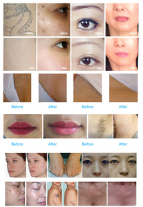 Taches de rousseur de tatouage 4in1 Machine d'épilation multifonction Super Power Movement Stable Effect Source Manufacturer - Product Image 6