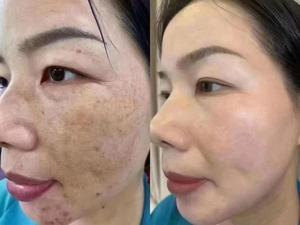 Crème à l'Astragale Hydratation Intense, Répare les Barrières Cutanées, Nourrissante, Éclaircissante, Atténue les Taches Jaunes Foncées pour Femmes à Peau Normale - Offre Spéciale - Product Image 2
