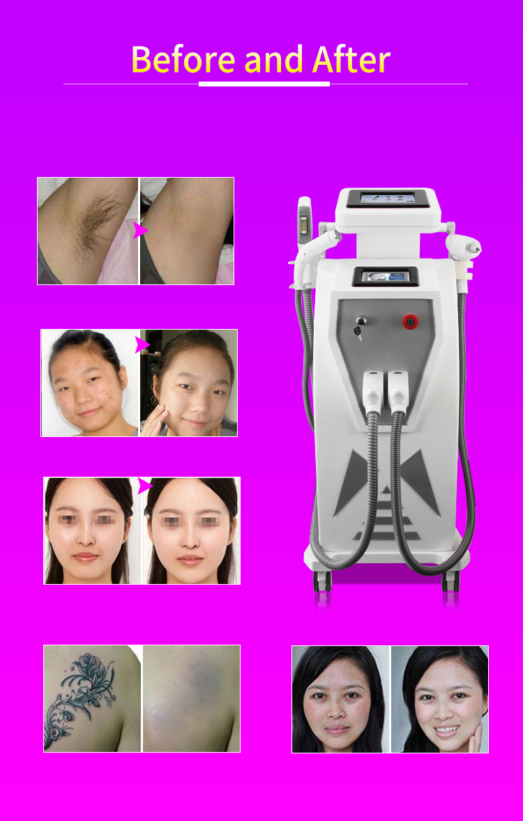Hottest 4 in 1 E-light Ipl Rf Nd Yag Laser Multifunction Hair Removal Machine