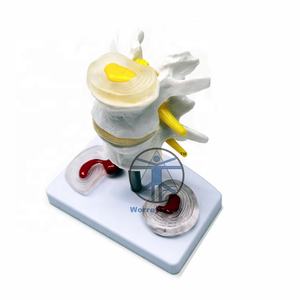 עמוד השדרה הרפואית אנדוסקופ אנדוסקופי השדרה ניתוח הוראת דגם transforaminal אנדוסקופ חולים עמוד השדרה דגם - Product Image 3