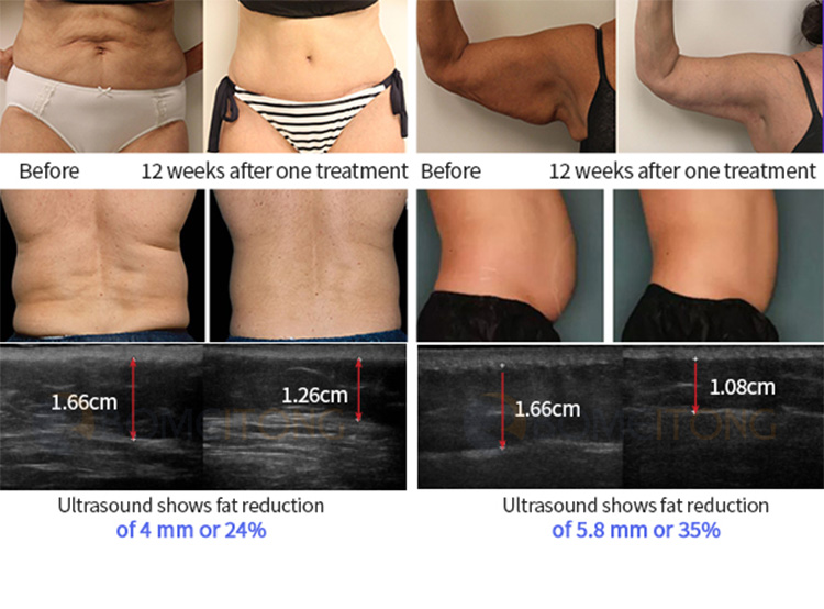 trusculpt treatment