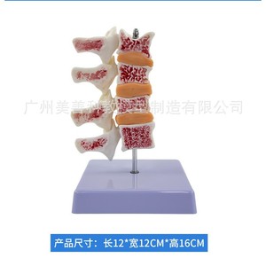 Simulation pédagogique de l'ostéoporose humaine, de la colonne vertébrale, des vertèbres lombaires, du squelette, de la structure osseuse, de la pathologie, des intervertèbres lombaires - Product Image 2