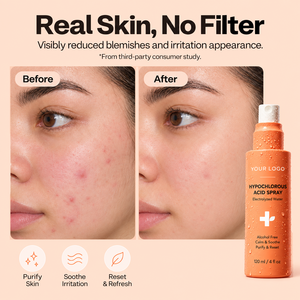 Spray Visage à l'Acide Hypochloreux Antibactérien, Conçu pour Peaux Sensibles, Améliore les Imperfections et l'Acné, Apaise les Rougeurs, les Coups de Soleil et les Irritations - Product Image 2