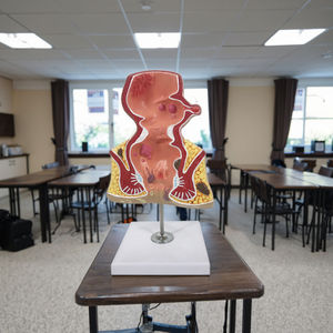 Modèle d'anatomie du rectum avec pathologies Modèle d'anatomie du rectum avec pathologies Démonstration de la maladie du rectum pour les sciences médicales - Product Image 3