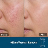 Appareil laser à diode 980 nm pour l'élimination vasculaire, traitement des varices et des capillaires