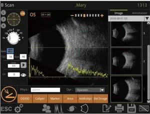 Nhãn khoa Máy retiwave 1000 AB scan cá nhân siêu âm Scanner A và B scan nhãn khoa cụ