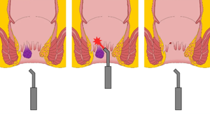Perawatan <span class=keywords><strong>Laser</strong></span> Wasir, Pemotongan Fisura Ani, Wasir (Bulu), Fistula Ani, Ablasi 980 1470nm, <span class=keywords><strong>Laser</strong></span> Proktologi - Product Image 6