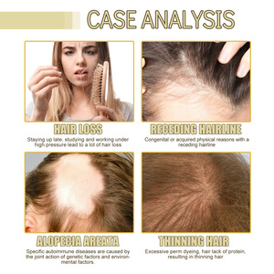 Custom 100% Natural Organic Rosemary Hair <strong>Scalp</strong> Care Treatment Regrowth Biotin Rosemary Essential <strong>Oil</strong> Growth <strong>Oil</strong> Serum - Product Image 3