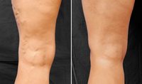 Appareil laser diode portable pour traitement des varices et des lésions vasculaires, chirurgie EVLT 1470 nm