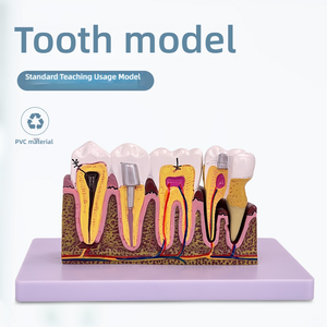 4X modèle de développement de caries dentaires en PVC agrandi pour l'éducation des patients et l'outil de formation dentaire - Product Image 4