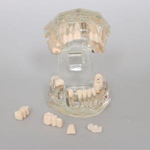 Modèle dentaire transparent de haute qualité, nouveau modèle d'affichage pathologique pour prothèses dentaires et implants - Product Image 3
