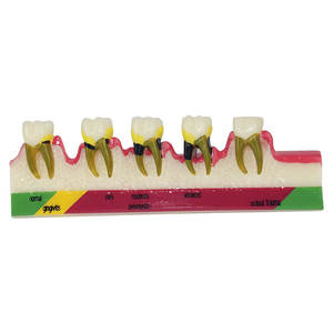 Modelo Anatómico de Periodoncia Oral para Gingivitis, Periodonitis Crónica, Clasificación de Grado, Comunicación Dental - Product Image 3