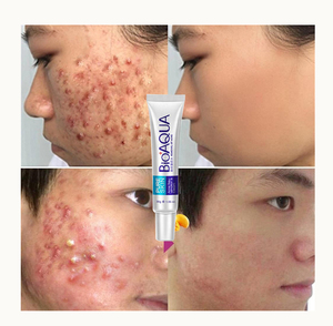 Crema Facial BIOAQUA para Eliminar el Acné, Controlar la Grasa, Reducir los Poros y Eliminar las Cicatrices del Acné - Product Image 1