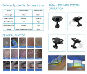 Tidak ada penggantian habis pakai, biaya pemeliharaan rendah sistem Excimer 308nm untuk eksim umum dan kronis - Product Image 5