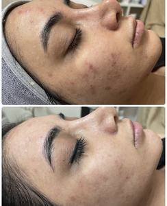 Meilleure vente masque raffermissant visage pour femmes poudre lyophilisée d'algues naturelles infusée d'acide hyaluronique sérum propre Bio Peeling - Product Image 6