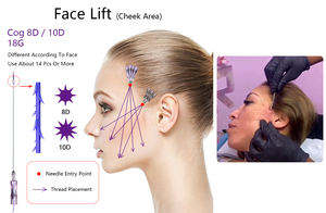 Mesotherapy Skin Tightening <strong>Blunt</strong> L <strong>Cannula</strong> 3D <strong>Cog</strong> Lifting Pdo Threads - Product Image 6