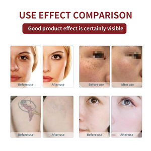 เครื่องลบรอยสักแบบเลเซอร์ Pico-ND-YAG แบบไม่มีสวิตช์ Q แบบมืออาชีพชีพจรยาว - Product Image 4