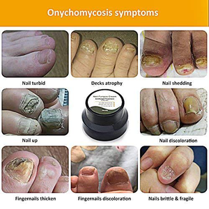 OEM/ODM <span class=keywords><strong>Mycose</strong></span> des Ongles <span class=keywords><strong>Crème</strong></span> Arrêt <span class=keywords><strong>Pied</strong></span> Champignon Champignon de Clou <span class=keywords><strong>Crème</strong></span> - Product Image 4