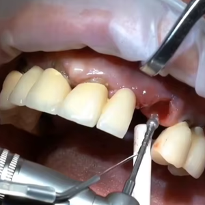 Multiuso Burs 4 Burs degranulazione Kit blocco per rimuovere i resti di tessuto attaccato all'osso - Product Image 3