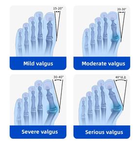 Nouveau Design de Redresseur d'Orteil Réglable Attelles Orthopédiques Correcteur d'Oignon Séparateur d'Orteil Sangle pour Hallux Valgus - Product Image 4