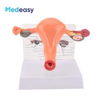 Modelo de anatomía del útero y ovario femenino Medeasy, modelo de útero normal y con enfermedades, con base desmontable para la enseñanza de enfermería médica