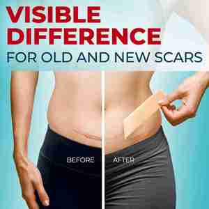 Cinta de silicona de grado médico para cicatrices, diferencia visible en queloides, láminas de silicona reutilizables para cicatrices - Fácil de usar - Product Image 6