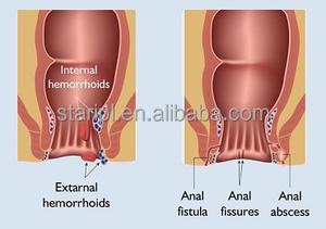 Eliminación de Hemorroides con Láser Portátil de 980nm y 1470nm, Diodo de Proctología para Hemorroidectomía, Fisura Anal, Fisura, Urología - Product Image 4