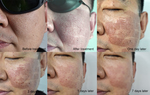 Macchina Laser CO2 Frazionale per Resurfacing Cutaneo Verticale, Rimozione Cicatrici, Vendita Promozionale - Product Image 6