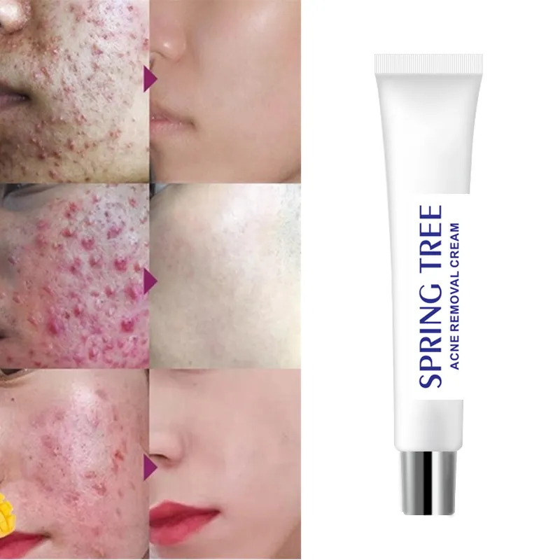 Tratamiento de la cicatriz del acné Crema blanqueadora facial 30g Control de aceite Reducir los poros Nutrir la piel Cicatriz del acné Eliminar la crema facial