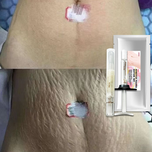 ODM OEM腹部紧致霜妊娠纹收紧腹部疤痕凝胶疤痕霜用于手术疤痕瘢痕疙瘩去除 - Product Image 2