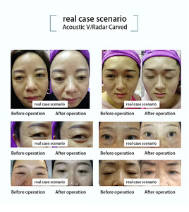 Máquina Portátil para Reafirmar la Piel, Blanquear y Rejuvenecer el Cuerpo y la Cara, Máquina Adelgazante - Product Image 3
