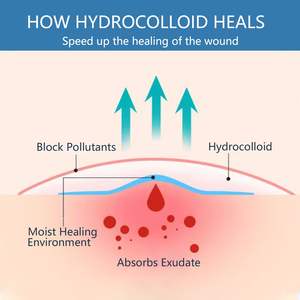 Parche hidrocoloidal extragrande autoadhesivo flexible, vendaje, Rollo hidrocoloidal - Product Image 4