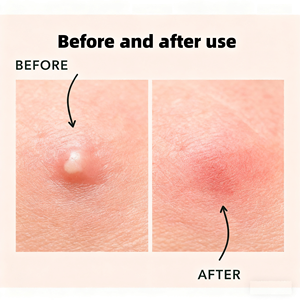 Loại bỏ mụn trứng cá Hydrocolloid mụn các bản vá lỗi giải pháp hiệu quả cho sự không hoàn hảo - Product Image 6