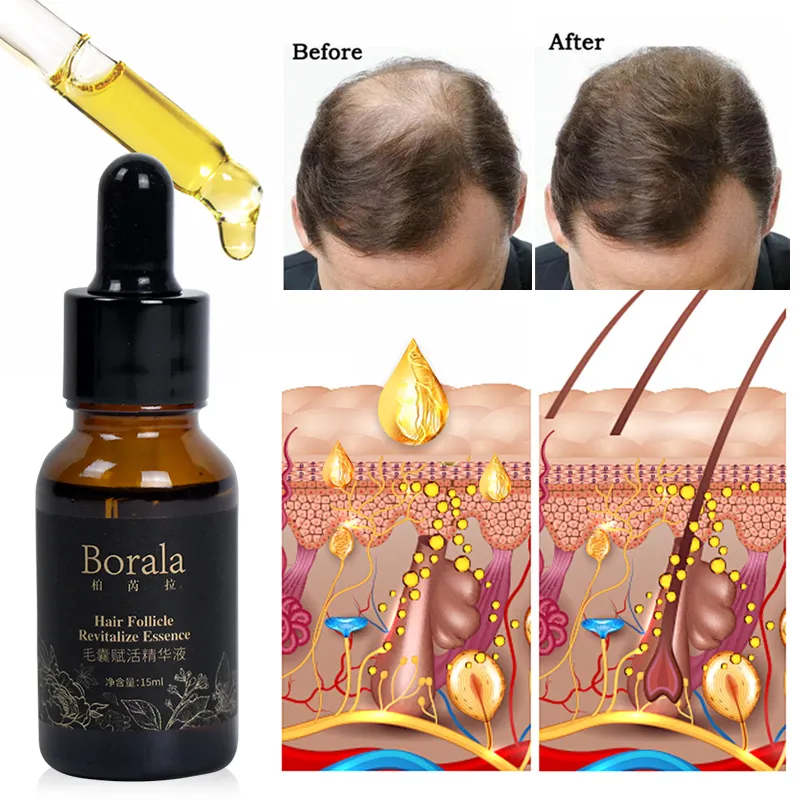 Restore Hairline Fast Hair Growth Serum Scalp Follicle Stimulation Essence