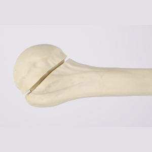 Kyrenmed cortical humerus ขวา fractureed กับ proximal humerus fracture สำหรับการประชุมเชิงปฏิบัติการการตัดเจาะ - Product Image 3